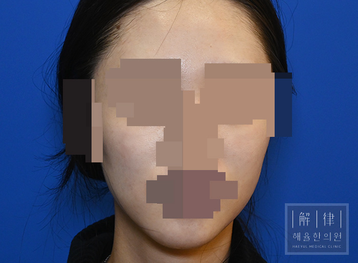[목동점] 얼굴화농성여드름 치료 후 사진 - 해율한의원